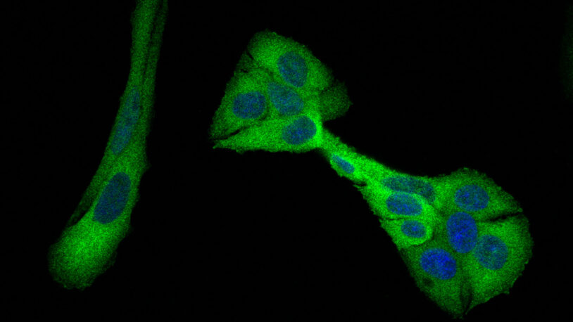 image of PHGDH enzyme in metabolic pathway in breast cancer cells