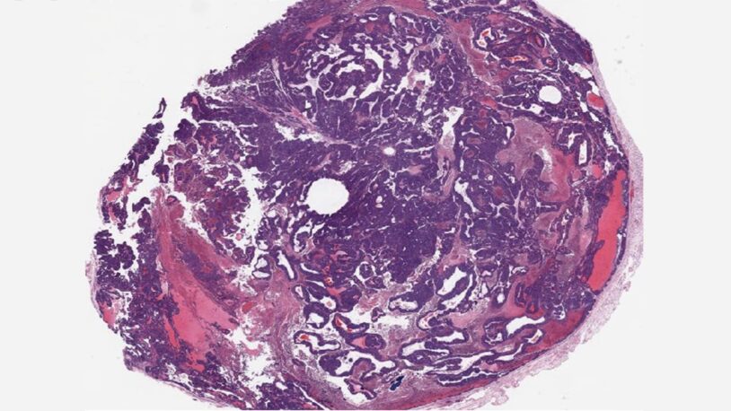 Image of a mammary tumor from a BPTF knockout mouse